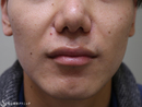 症例写真 術後 プレミアムPRP皮膚再生療法鼻尖縮小（外側法）＋小鼻縮小（1ヶ月後）