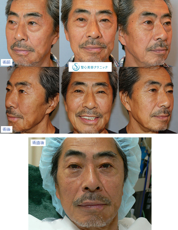 症例写真 術前後比較 目のくま・くぼみ・たるみ・眼瞼下垂