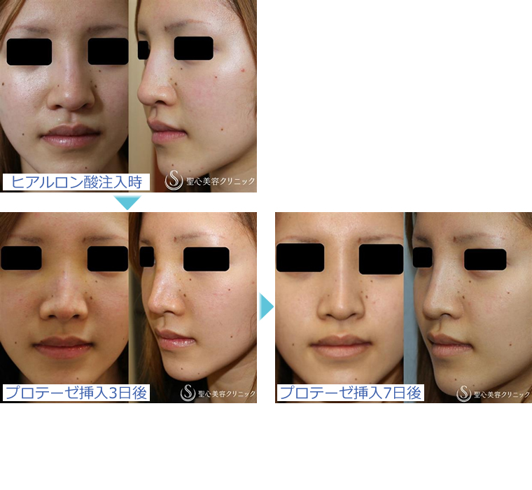 症例写真 術前後比較 鼻の整形