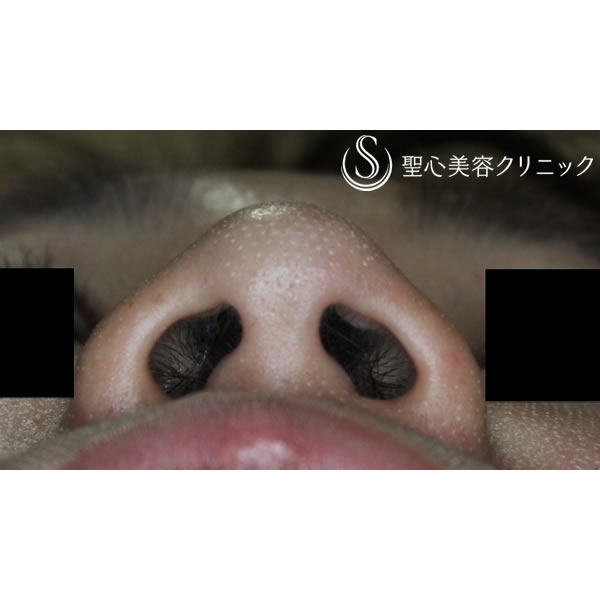 症例写真 術前 鼻の整形