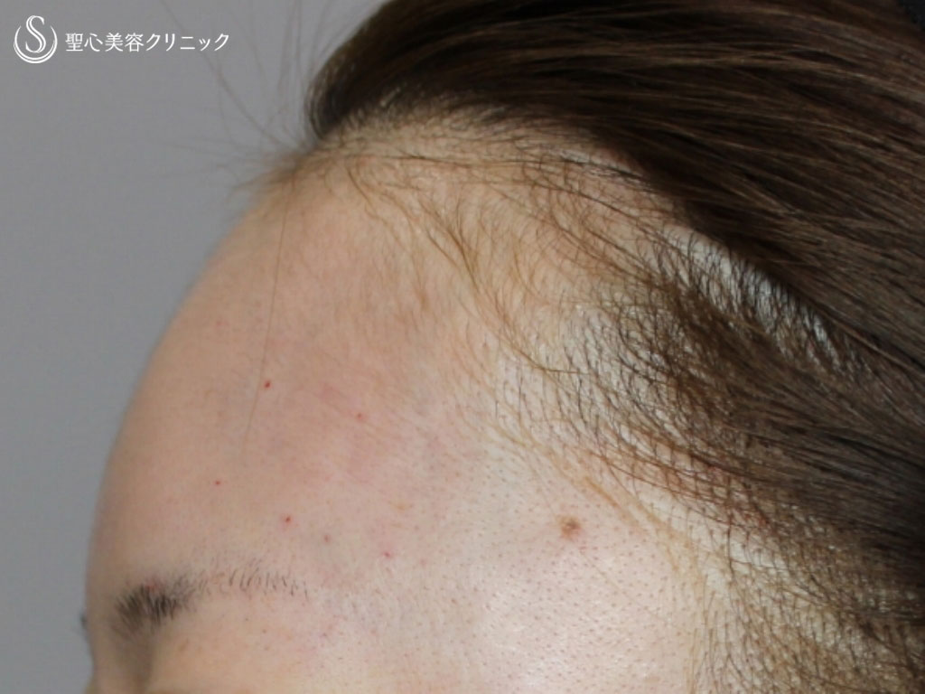 症例写真 術後 額のヒアルロン酸注入