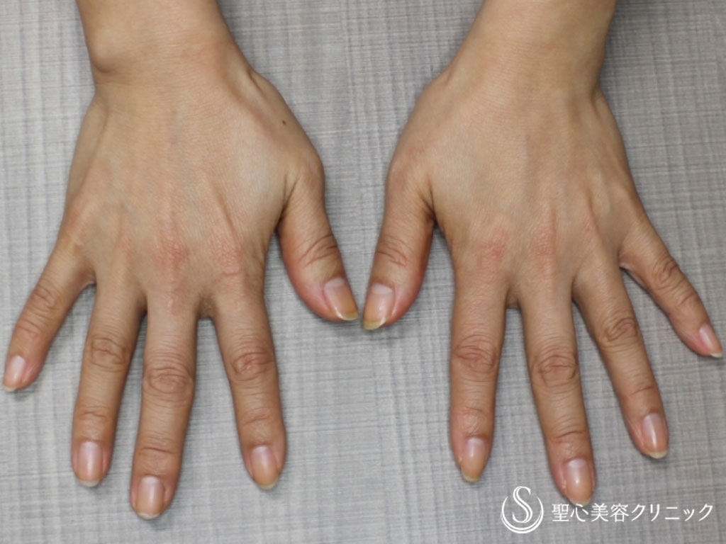 症例写真 術前 プレミアムPRP皮膚再生療法