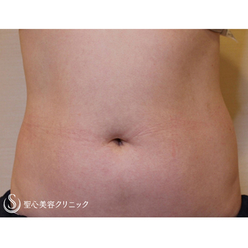 症例写真 術前 ベイザーリポ2.2脂肪吸引 腹部