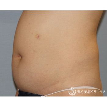 症例写真 術前 ベイザーリポ2.2脂肪吸引 腹部