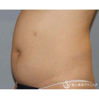 症例写真 術前 ベイザーリポ2.2脂肪吸引 腹部