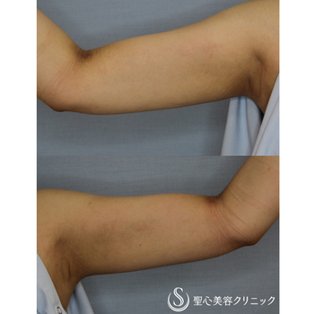 症例写真 術後 ベイザーリポ2.2脂肪吸引 二の腕