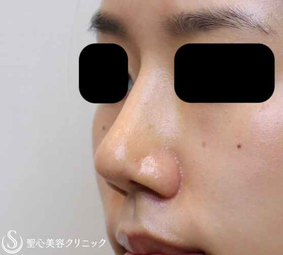 症例写真 術後 鼻プロテーゼ+鼻尖縮小+耳介軟骨移植