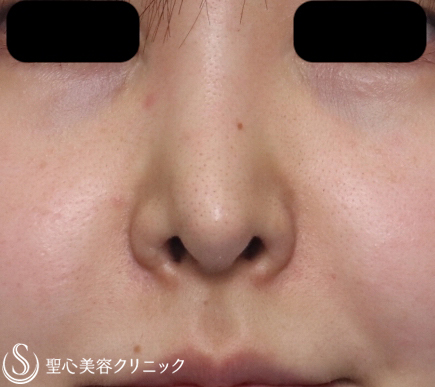鼻の整形 低い鼻 鼻筋 の症例写真 聖心美容クリニック名古屋院