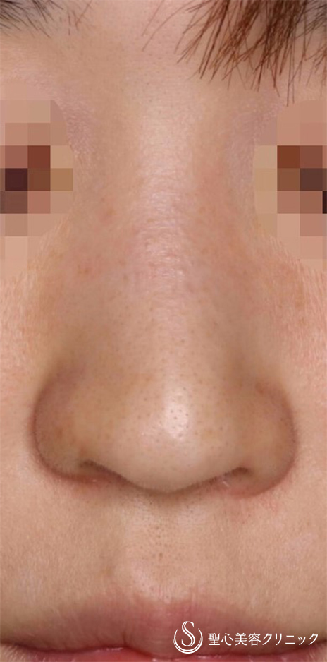 鼻の整形 低い鼻 の症例写真 聖心美容クリニック名古屋院