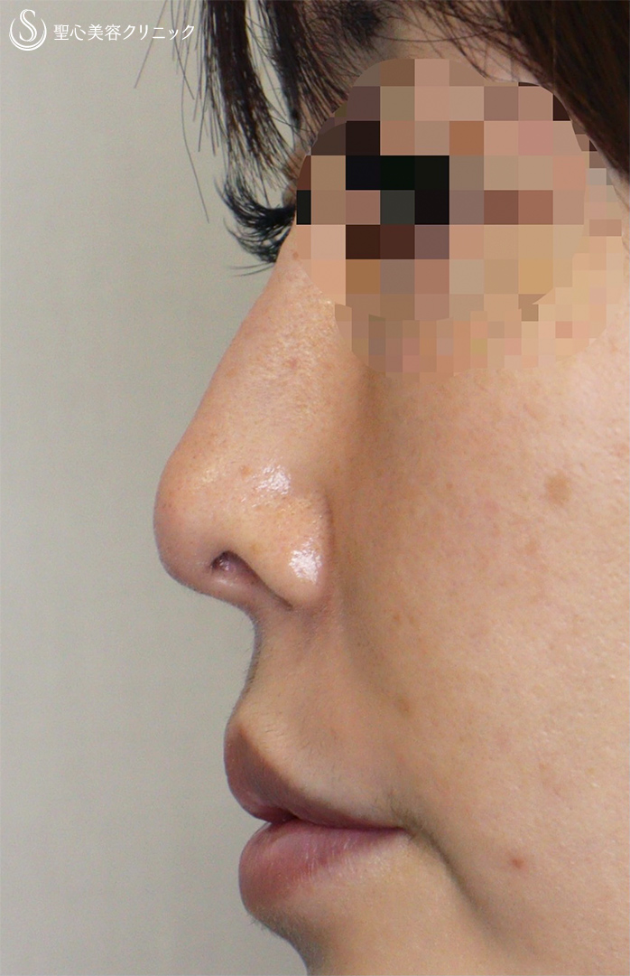 鼻の整形 低い鼻 鼻筋 の症例写真 聖心美容クリニック名古屋院
