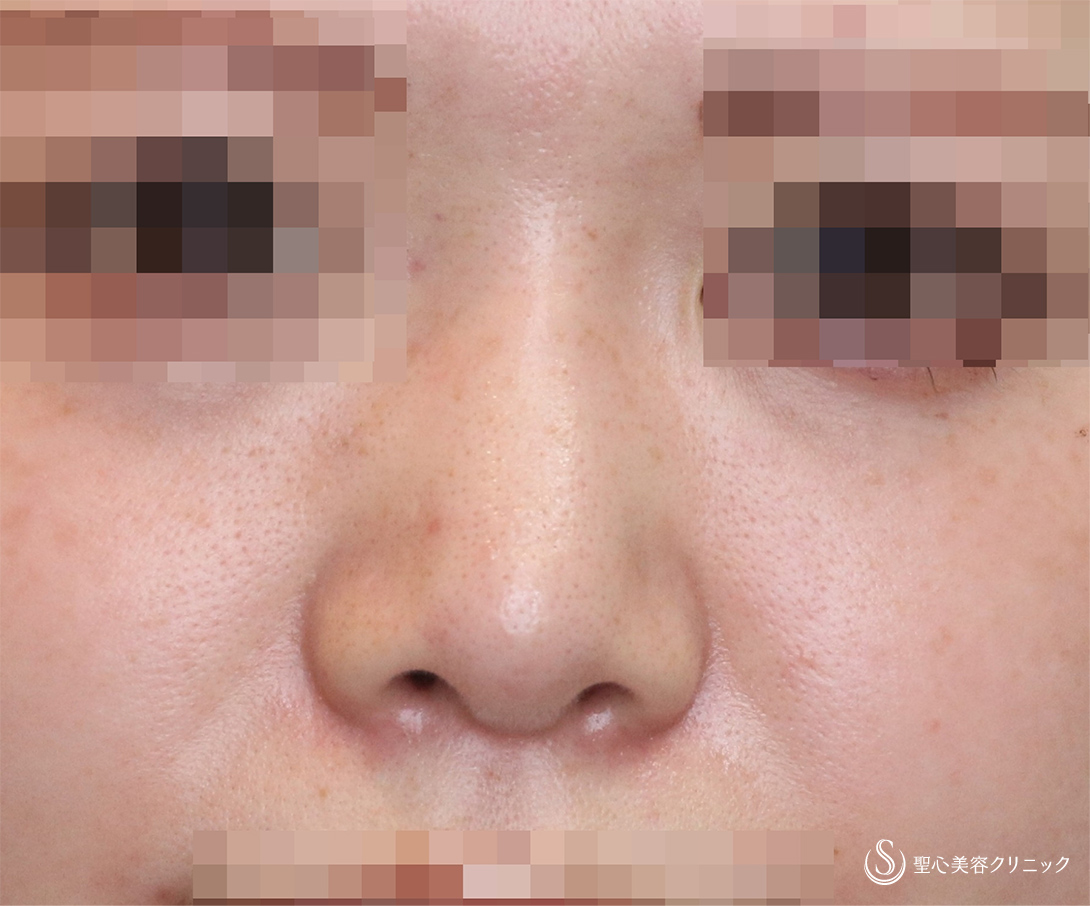 鼻の整形 低い鼻 の症例写真 聖心美容クリニック名古屋院