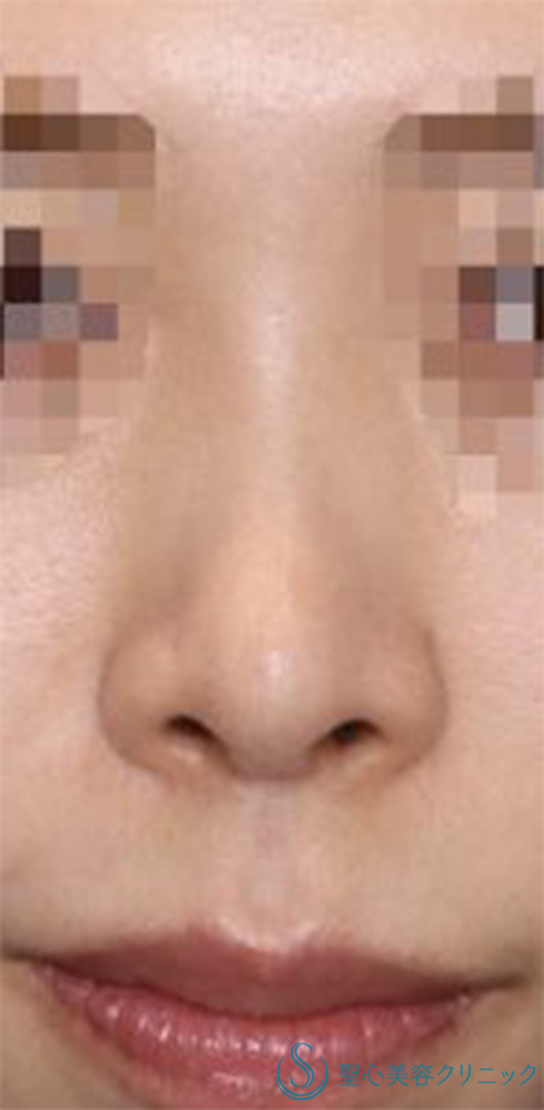 鼻尖縮小+鼻尖形成（耳介軟骨移植）+G-Mesh（Gメッシュ）+鼻尖形成（ストラット法）_After