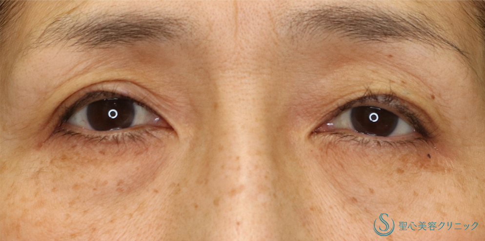  眼瞼下垂（埋没法）_After