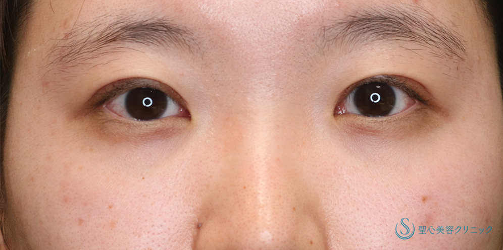  眼瞼下垂（切開法/腱膜縫縮法）_After