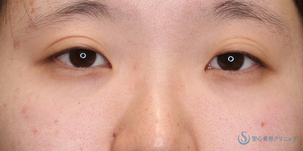  眼瞼下垂（切開法/腱膜縫縮法）_Before