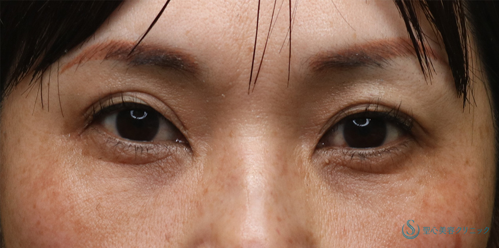  プレミアムPRP皮膚再生療法（目の下のくま）_After