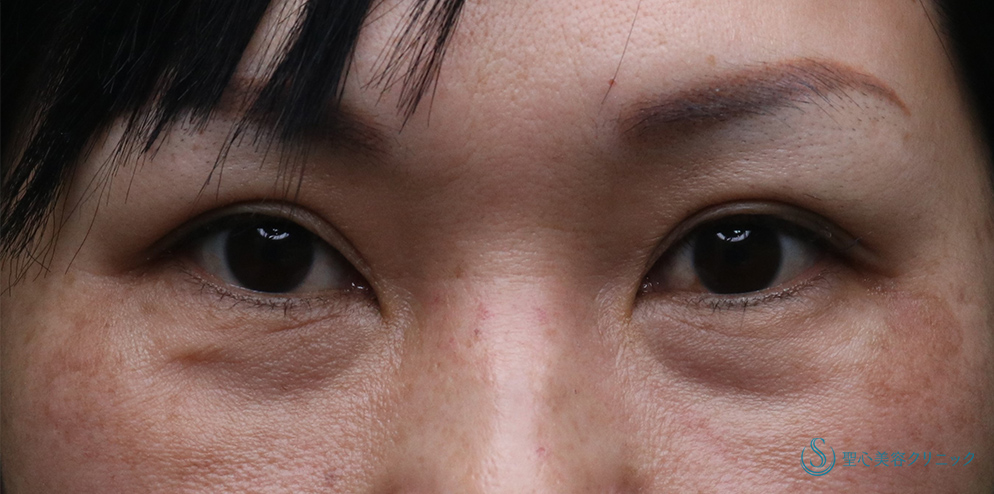  プレミアムPRP皮膚再生療法（目の下のくま）_Before