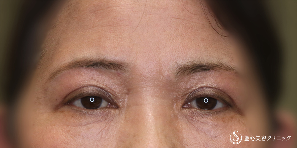  眉下切開法（眉下リフト）_After