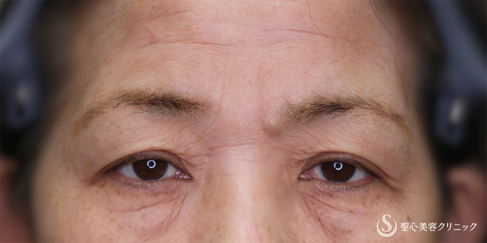  眉下切開法（眉下リフト）_Before