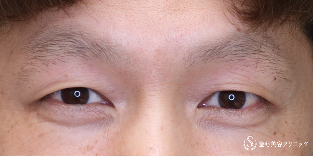  二重術（切開法）部分切開/全切開+脂肪除去_Before