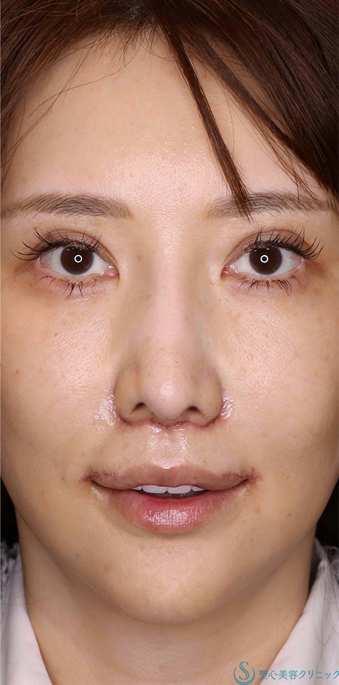 プレミアムリップリフト（プレミアム人中短縮術）＋外側人中短縮術_After
