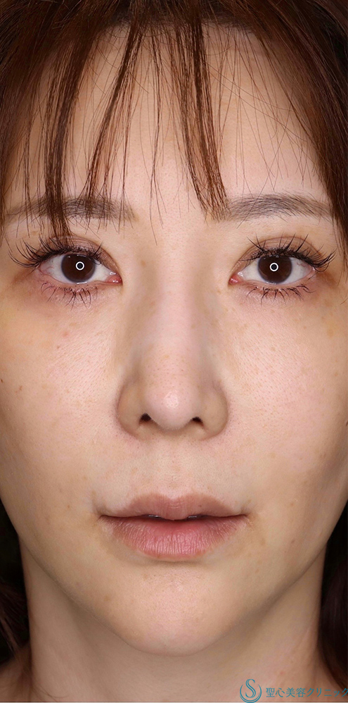プレミアムリップリフト（プレミアム人中短縮術）＋外側人中短縮術_Before