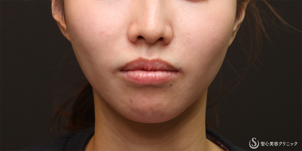  プレミアムPRP皮膚再生療法_After