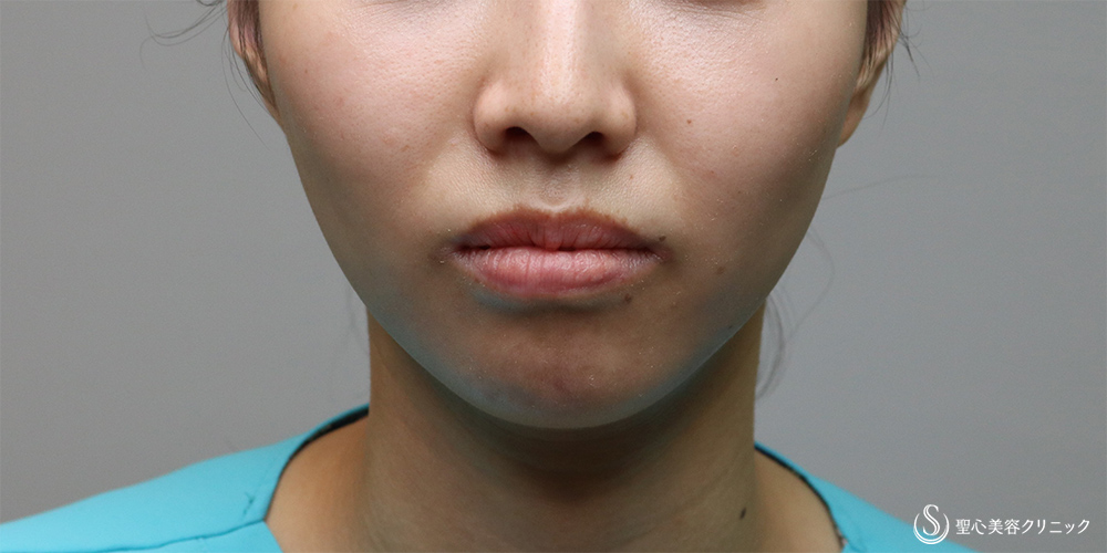  プレミアムPRP皮膚再生療法_Before