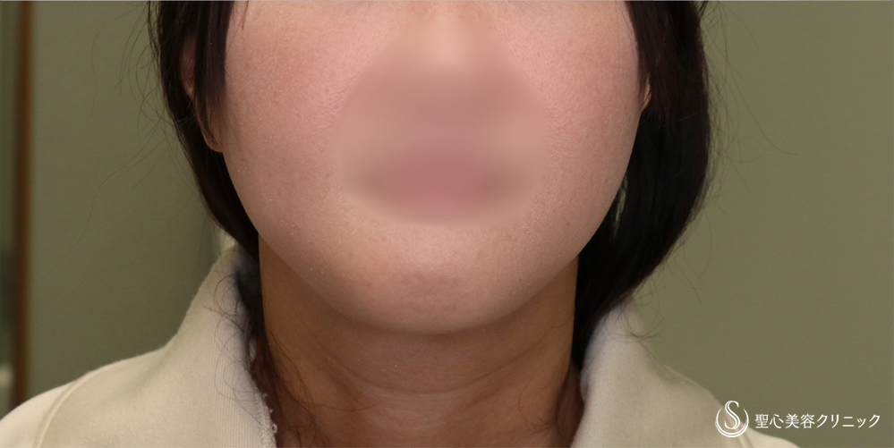 ベイザーリポ2.2脂肪吸引_After