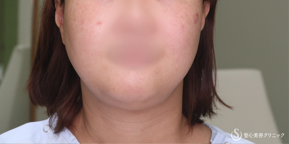 ベイザーリポ2.2脂肪吸引_Before