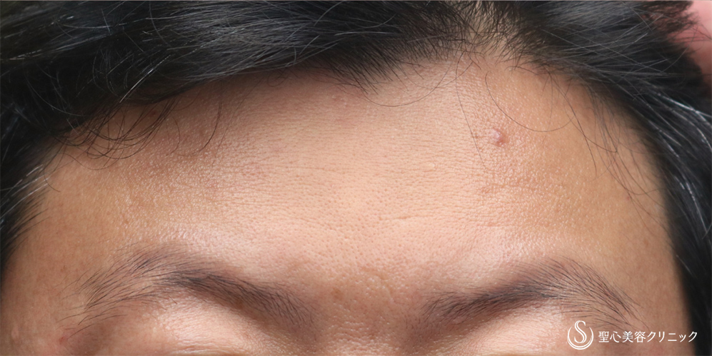  プレミアムPRP皮膚再生療法_After