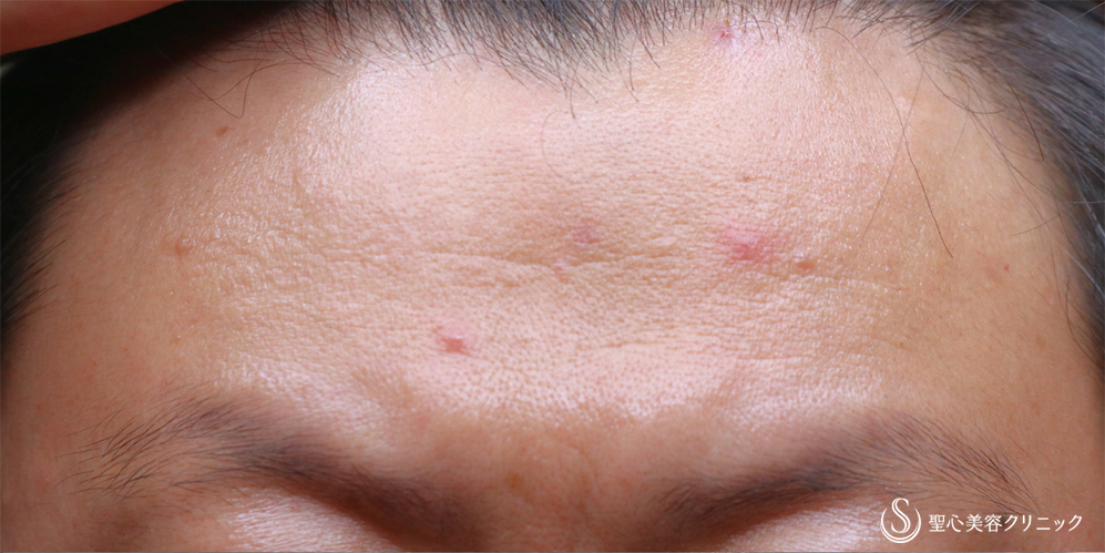 プレミアムPRP皮膚再生療法_Before