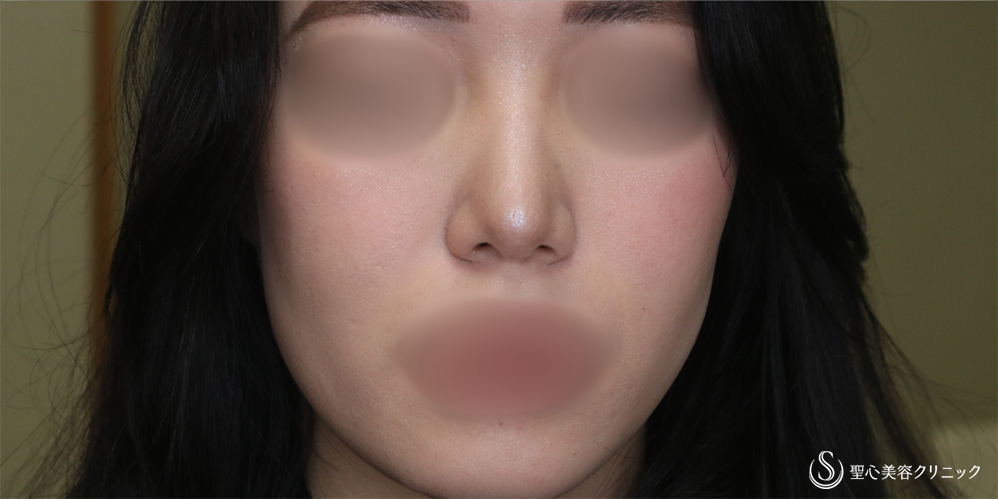 鼻尖縮小＋鼻尖形成（耳介軟骨移植）_After
