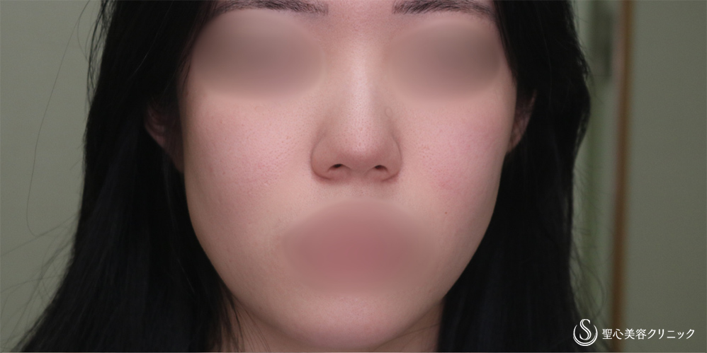 鼻尖縮小＋鼻尖形成（耳介軟骨移植）_Before