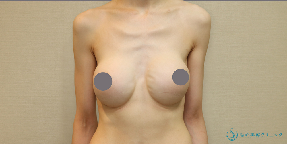  バッグプロテーゼ挿入法_Before