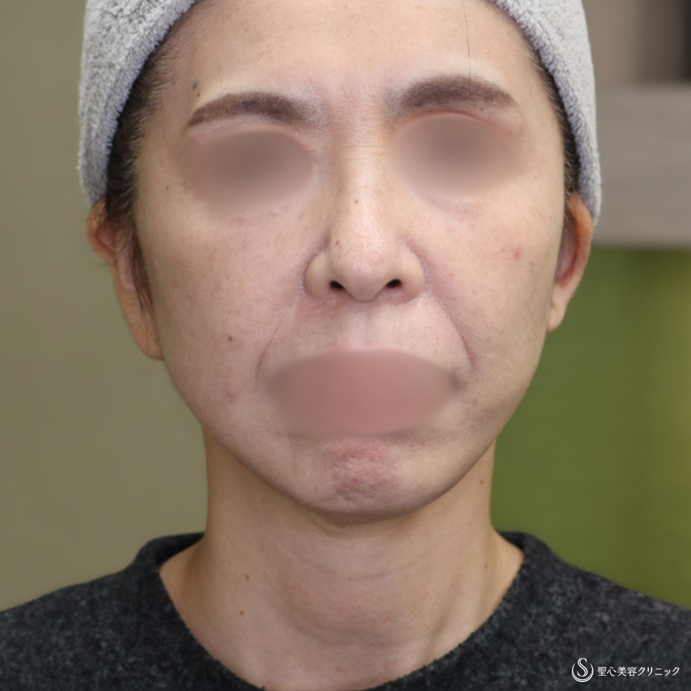  フェイスリフト_After