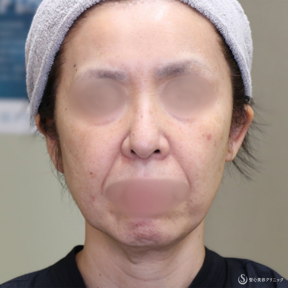  フェイスリフト_Before