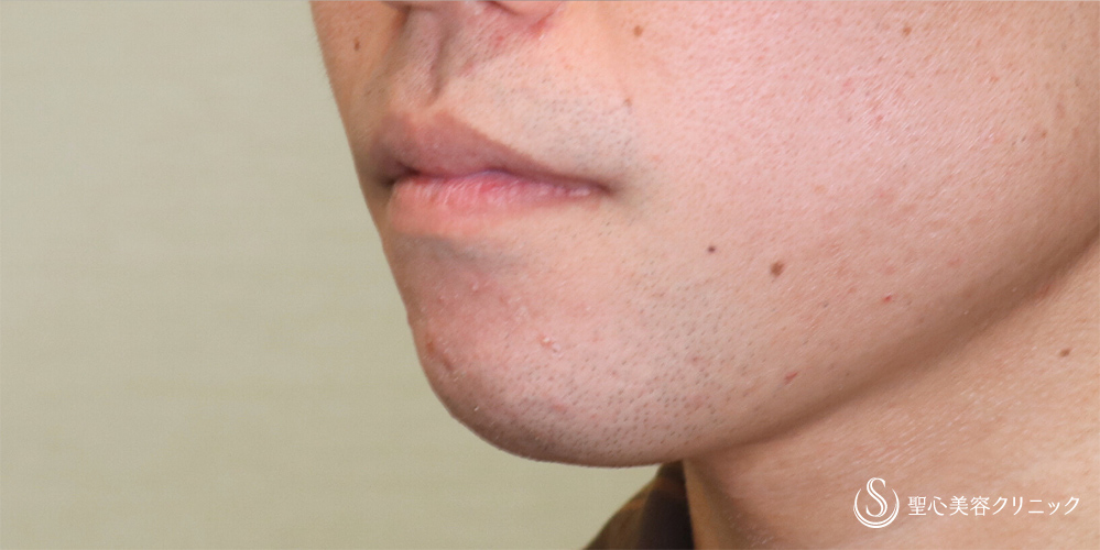  あごプロテーゼ_After