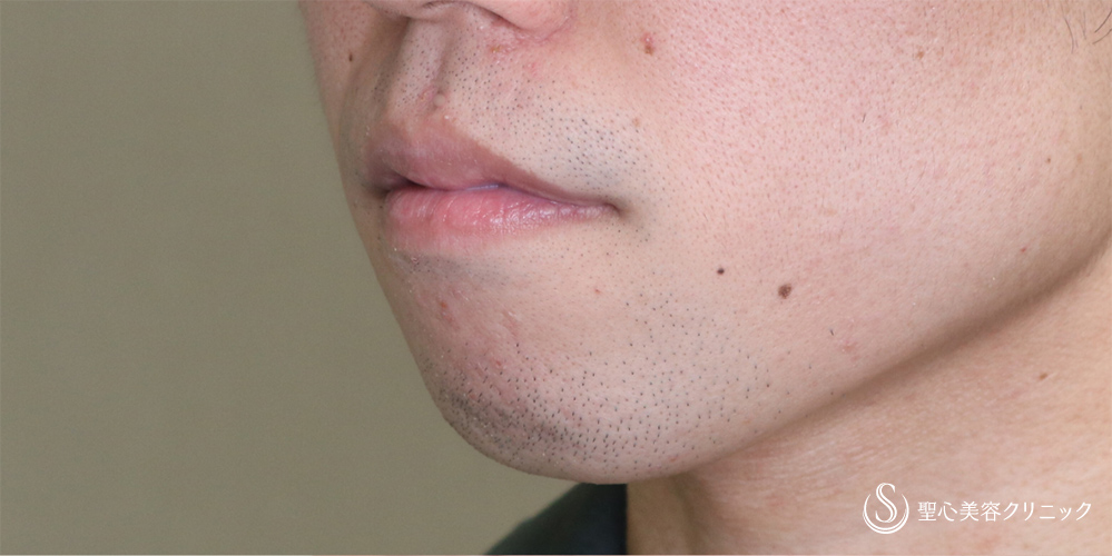  あごプロテーゼ_Before