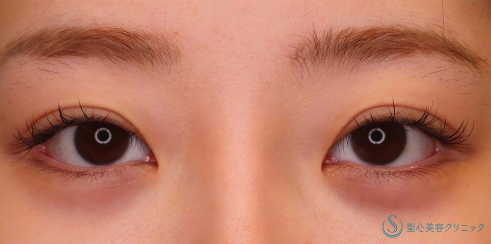 目頭切開/目上切開_Before