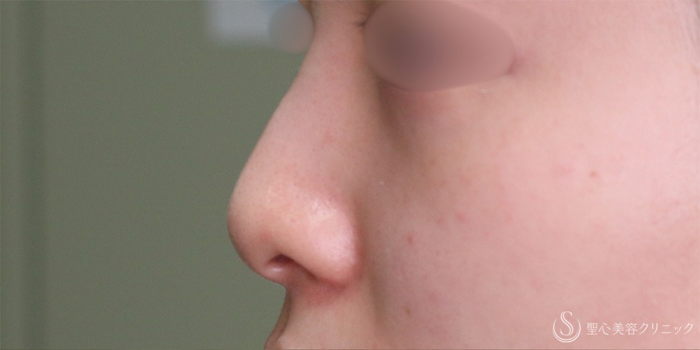 鼻尖縮小＋耳介軟骨移植_Before