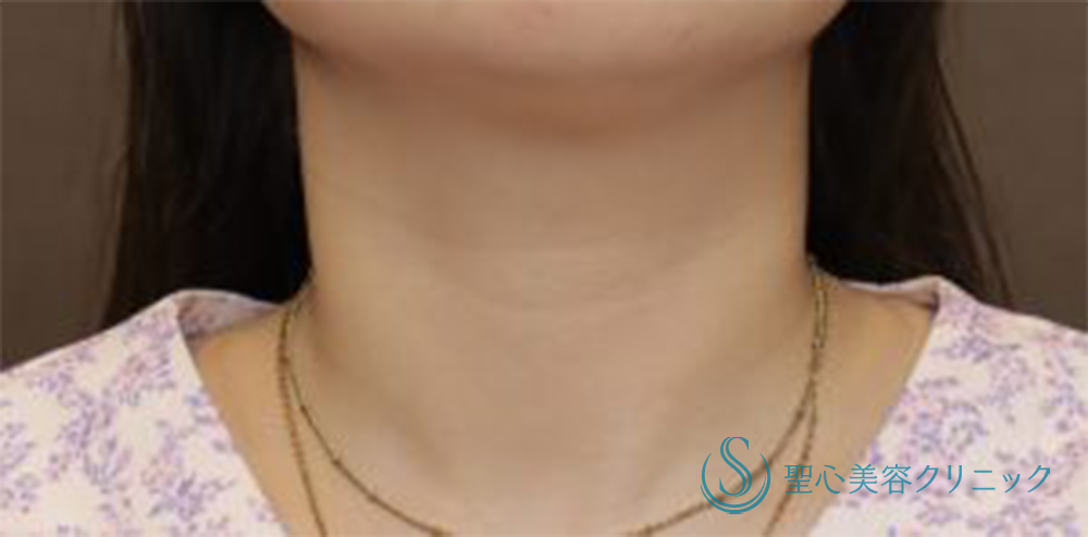 プレミアムPRP皮膚再生療法_After