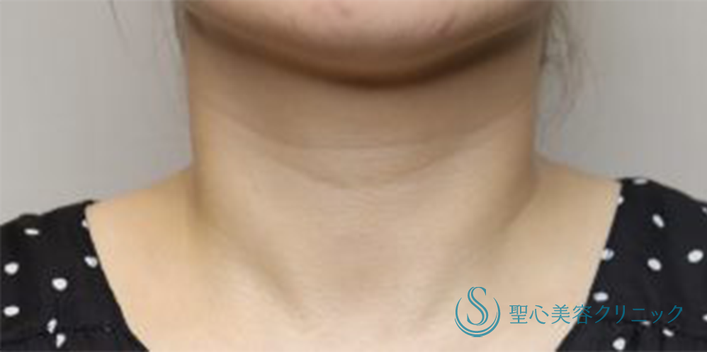 プレミアムPRP皮膚再生療法_Before