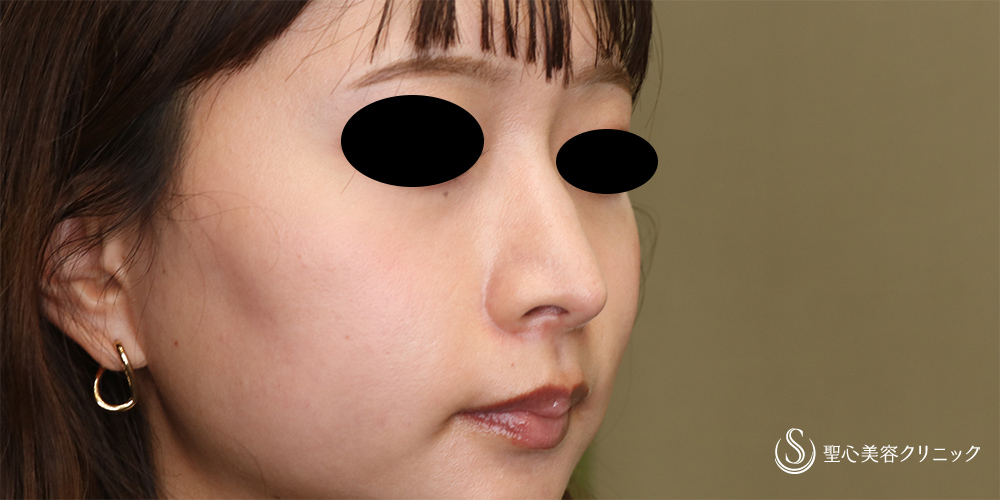 鼻尖縮小＋鼻尖形成（耳介軟骨移植）_After