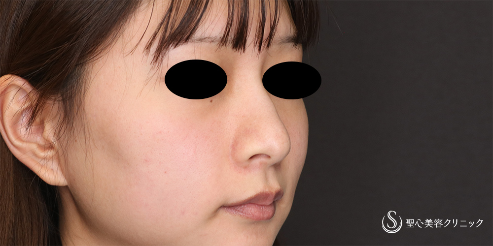 鼻尖縮小＋鼻尖形成（耳介軟骨移植）_Before