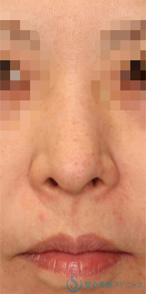 鼻孔縁下降術_Before