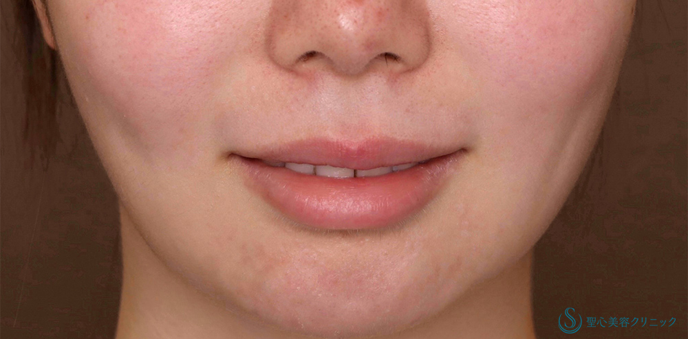 鼻下短縮術（リップリフト/人中短縮）_Before