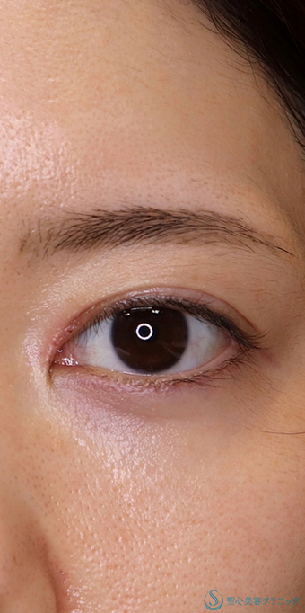 目頭切開/目上切開＋他院修正_After