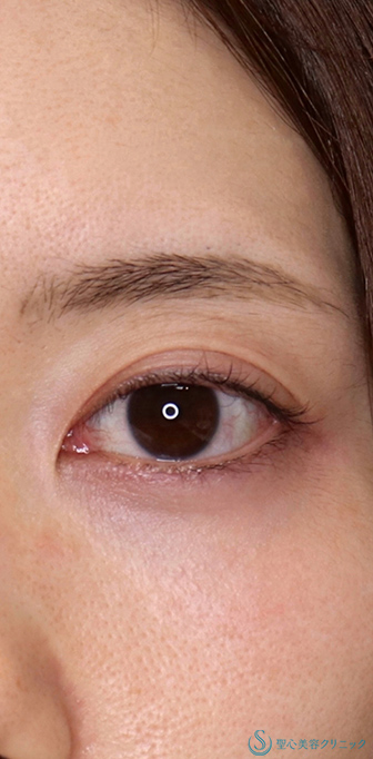 目頭切開/目上切開＋他院修正_Before