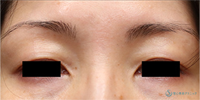 プレミアムPRP皮膚再生療法_After